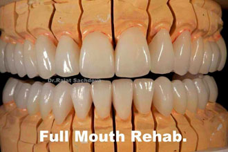 Dental Implant Is Really More Than Just A Treatment!!
