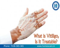 Image for Homeopathy Treatment for Vitiligo in Abids