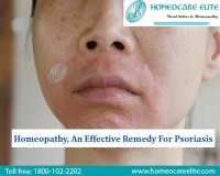Image for Now Psoriasis Is Curable With Homeopathy 