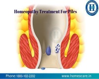 Image for Cure Piles With Homeopathy in Indira Nagar