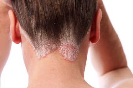  Psoriasis Treatment by Best Dermatologist in Mumbai